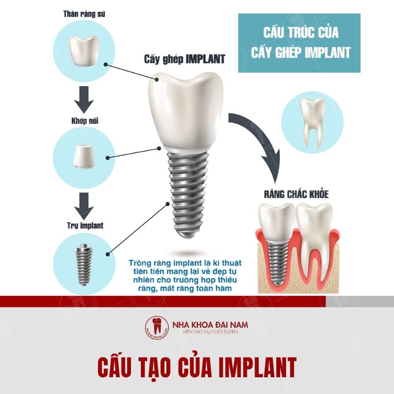 Cac thanh phan chinh cau tao cua tru Implant