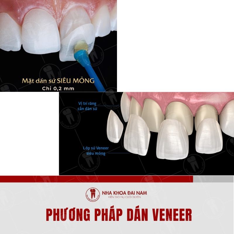 Phuong phap dan su veneer de cai thien tinh trang rang o vang va thua