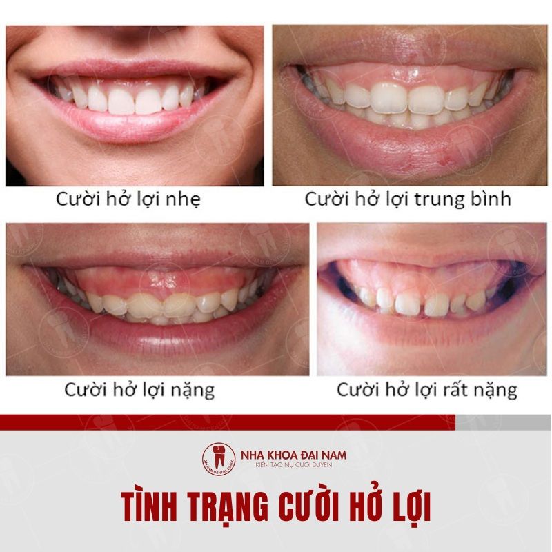 Dieu tri tinh trang ho loi giup ban co duoc nu cuoi dep hon