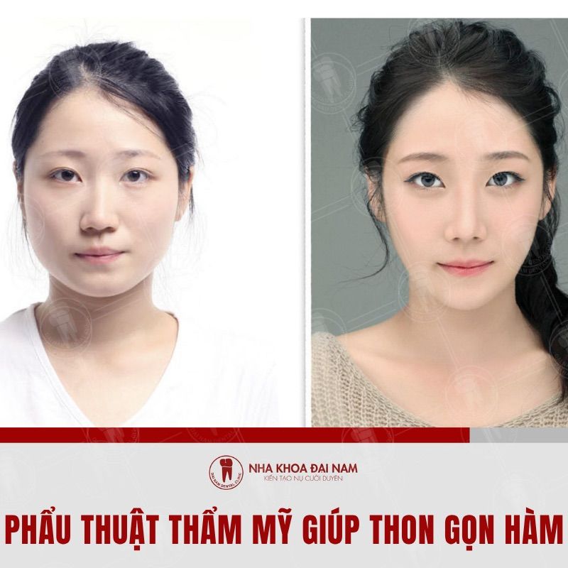 Phau thuat tham my thanh khuon mat trai xoan
