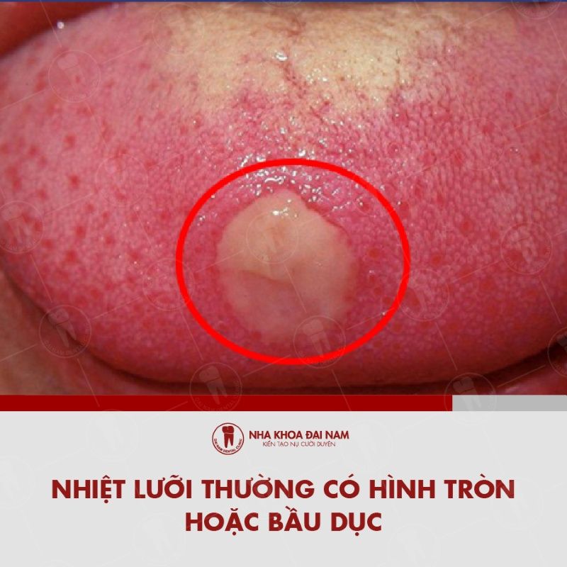 Nhiet luoi thuong co hinh tron hoac bau duc