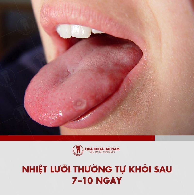 Nhiet luoi thuong se tu khoi sau 7 10 ngay