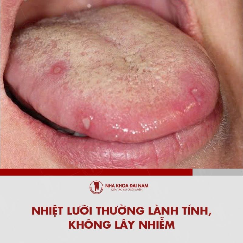 Nhiet luoi thuong lanh tinh va khong lay nhiem
