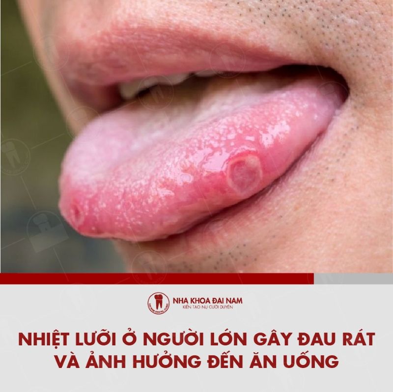 Nhiet luoi o nguoi lon gay dau rat anh huong den an uong