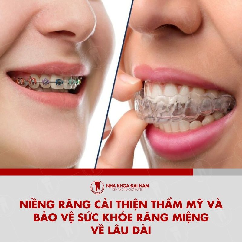 Nieng rang giup cai thien tham my va bao ve suc khoe rang mieng lau dai