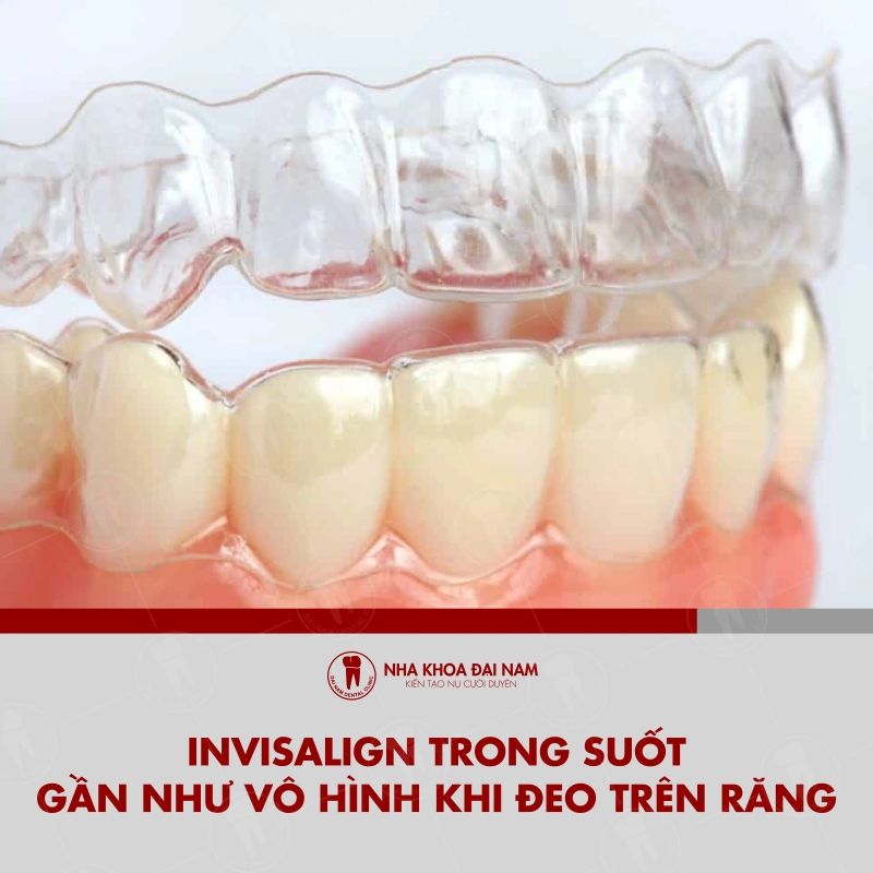 Khay nieng trong suot Invisalign gan nhu vo hinh khi deo tren rang