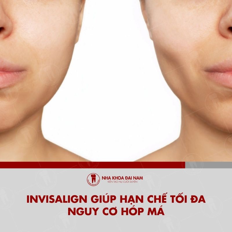 Nieng rang Invisalign co uu diem giup han che toi da nguy co hop ma