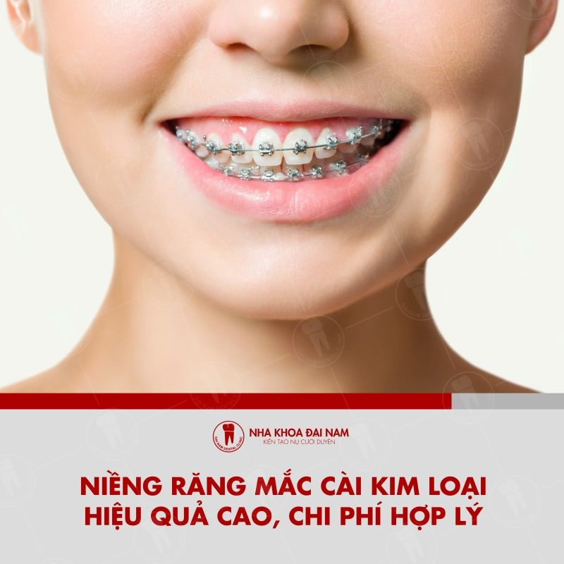 Nieng rang mac cai kim loai tai Quan 7 co chi phi hop ly