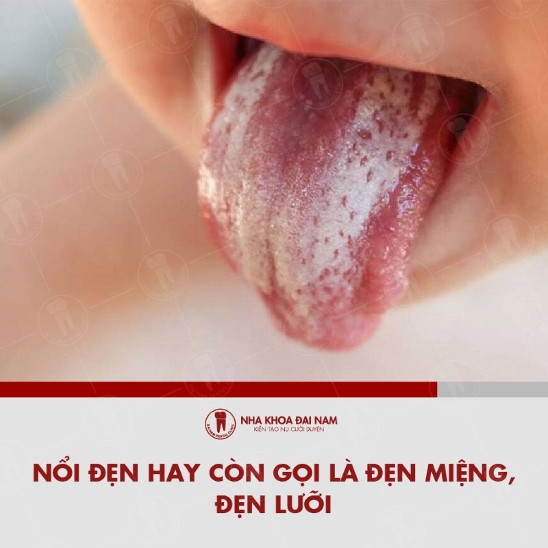 Noi den la hien tuong nhiem trung do nam Candida albicans gay ra