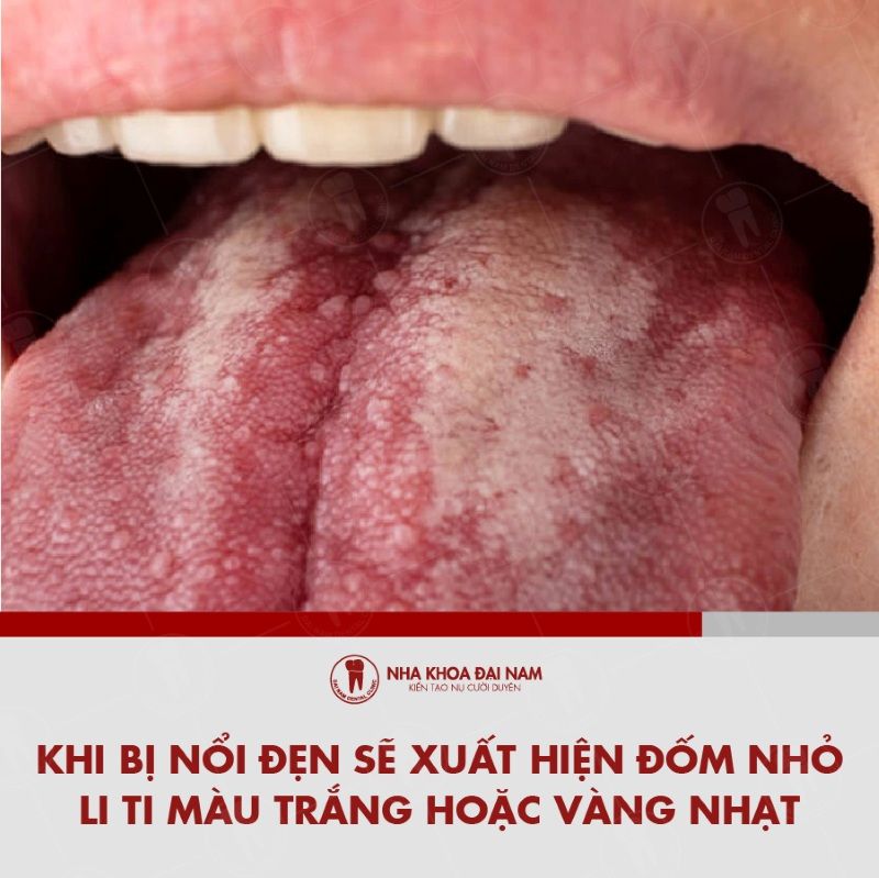 Khi bi noi den se xuat hien nhung dom nho li ti mau trang hoac vang nhat