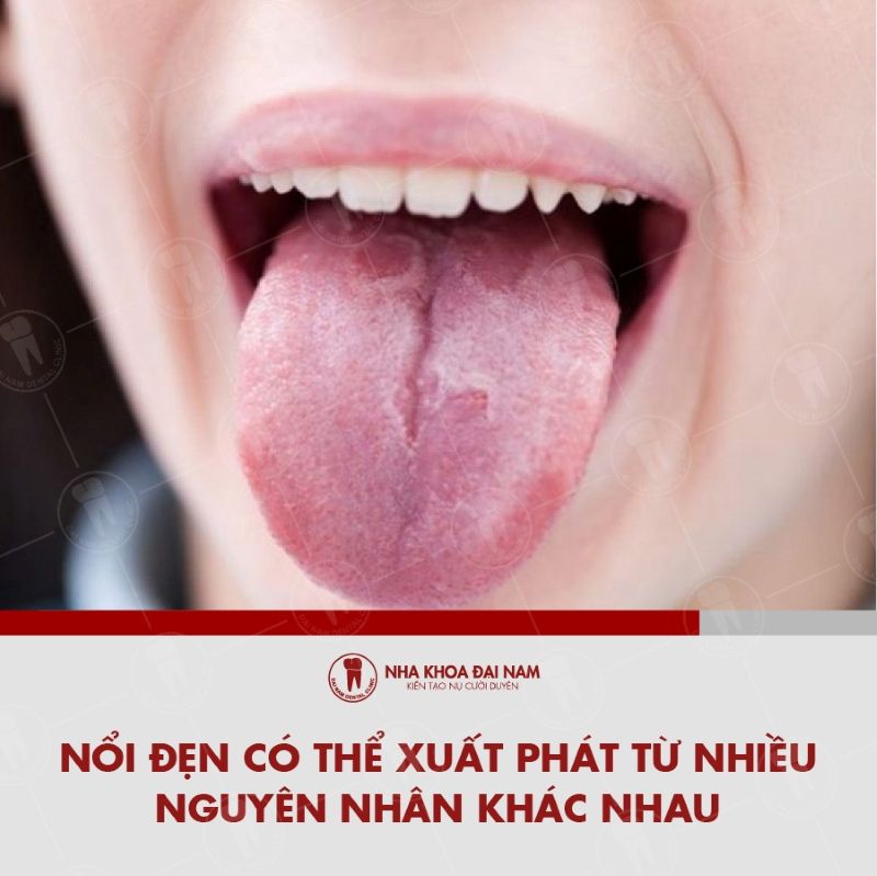 Noi den trong mieng hoac o luoi co the xuat phat tu nhieu nguyen nhan khac nhau