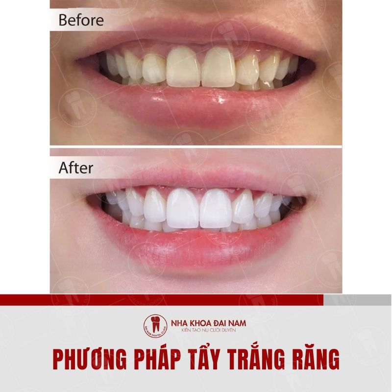 Phuong phap tay trang rang danh do nhung nguoi co tinh trang rang xin mau o vang