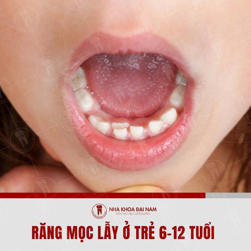 Tinh trang rang moc lay o tre em tu 6 12 tuoi