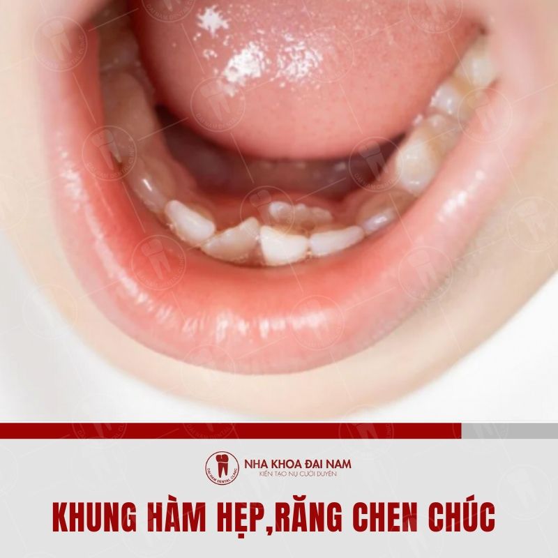 Khung ham hep la nguyen nhan khien rang moc lay