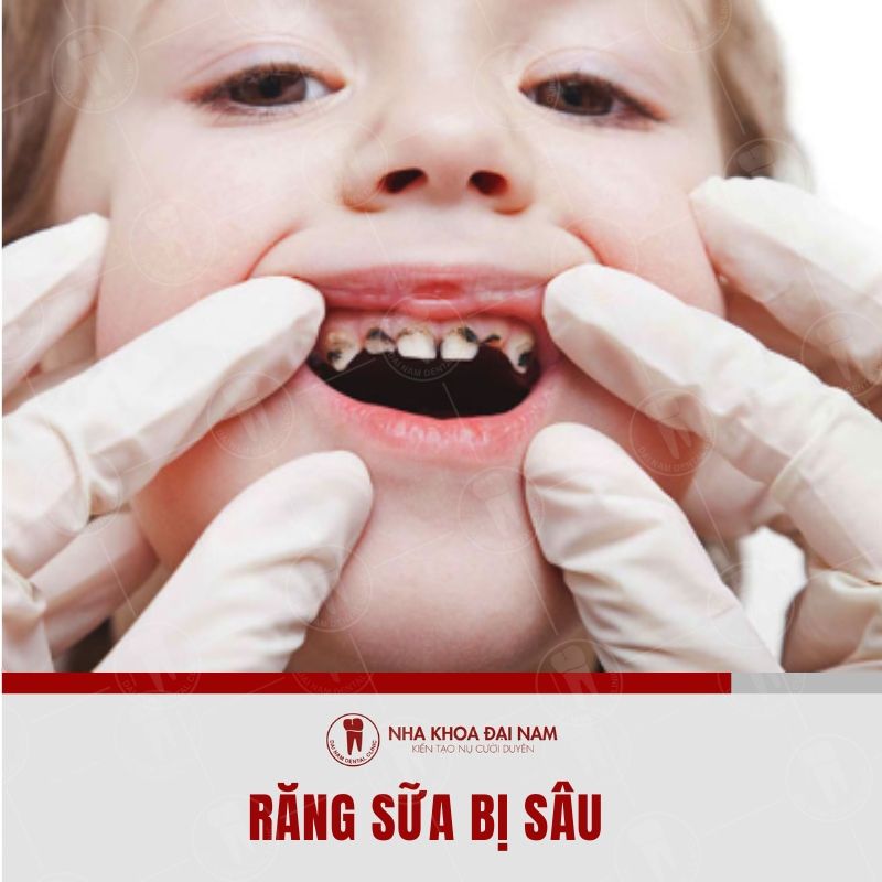 Rang sua cua tre bi sau con la nguyen nhan khien tre bi moc rang lay