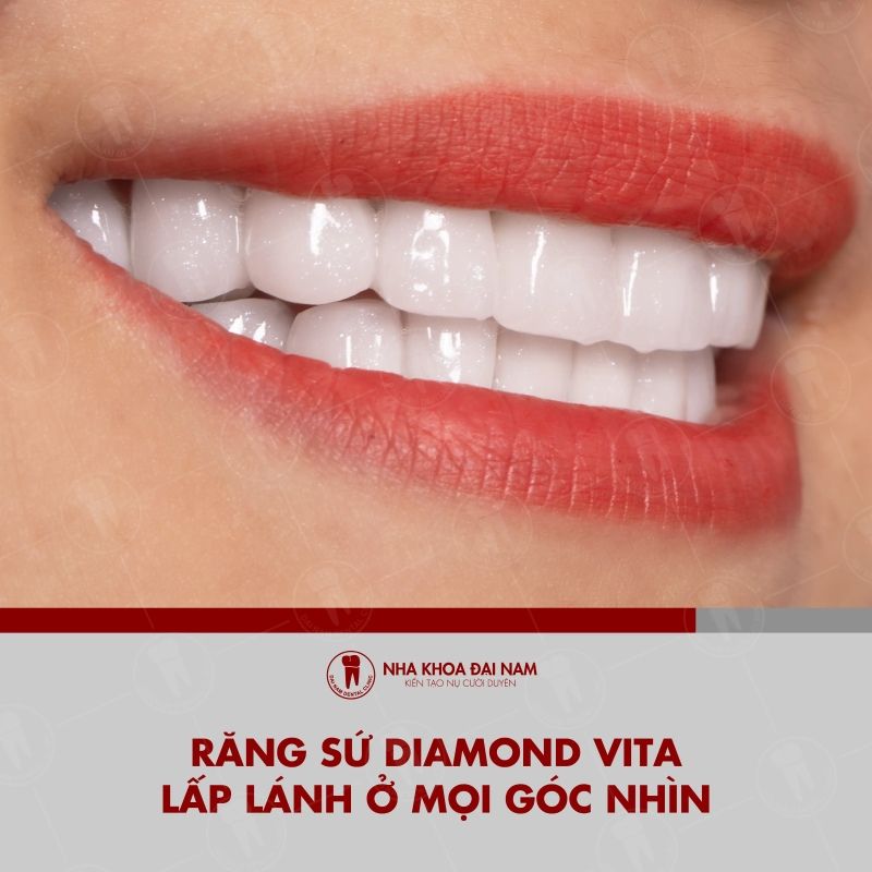 Rang su Diamond Vita chua tinh the kim cuong non la lua chon hoan hao de nang cap nu cuoi