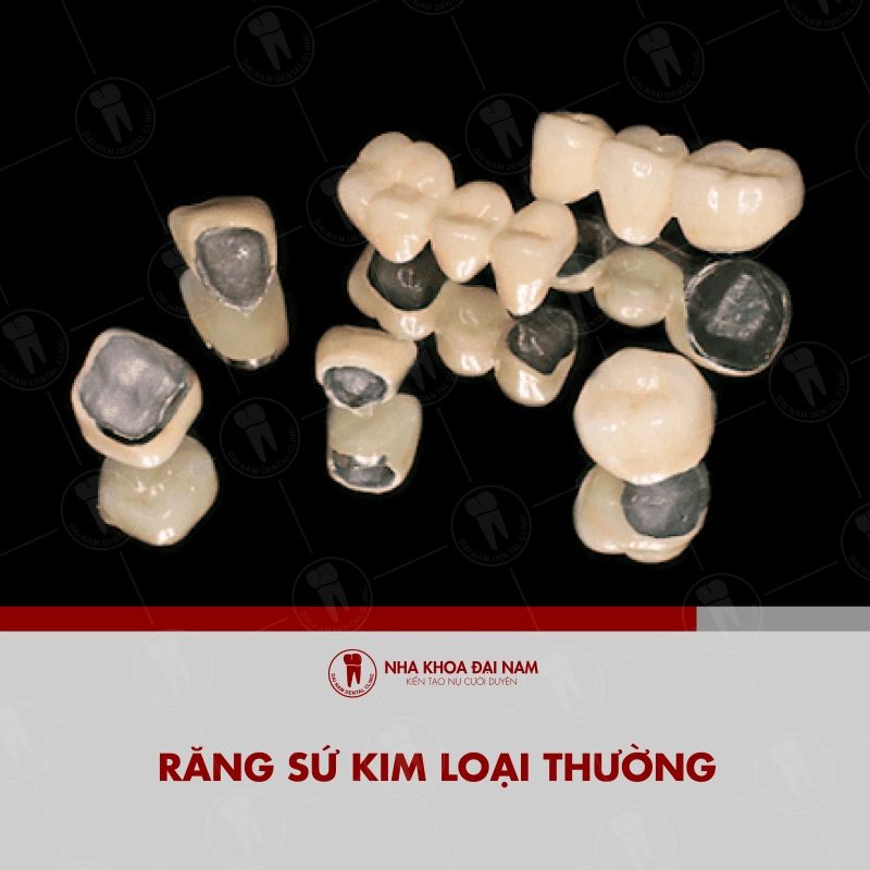 Rang su kim loai thuong la lua chon pho bien cho nhung ai can phuc hinh rang voi chi phi tiet kiem
