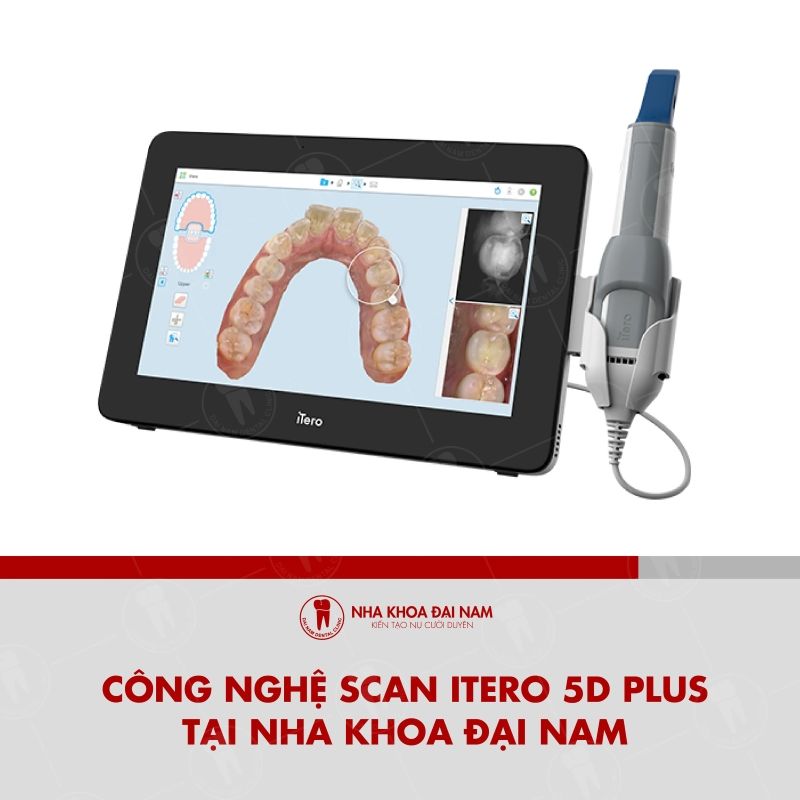Cong nghe Scan Itero 5D Plus tai Nha khoa Dai Nam