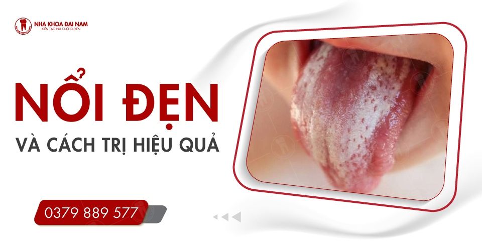 NỔI ĐẸN LÀ GÌ? CÁCH TRỊ NỔI ĐẸN TRONG MIỆNG HIỆU QUẢ