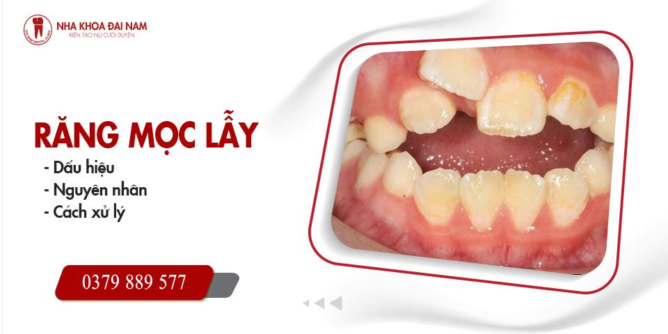 Răng Mọc Lẫy: Dấu Hiệu, Nguyên Nhân, Cách Xử Lý Hiệu Quả
