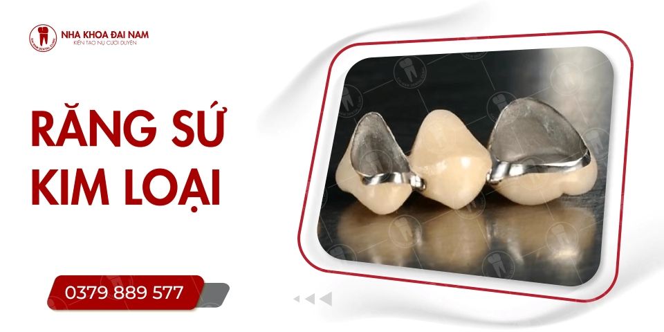 RĂNG SỨ KIM LOẠI CÓ MẤY LOẠI? RĂNG SỨ KIM LOẠI CÓ BỀN KHÔNG?