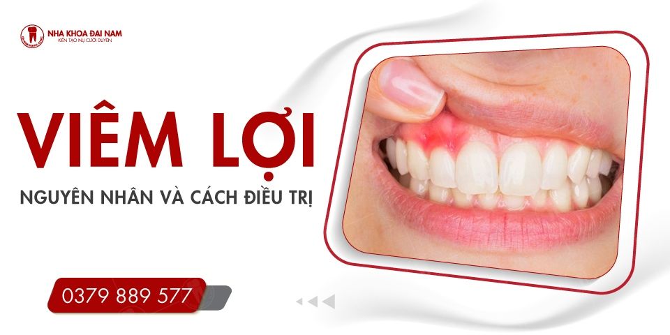 Viêm Lợi - Nguyên Nhân, Dấu Hiệu và Cách Điều Trị Hiệu Quả
