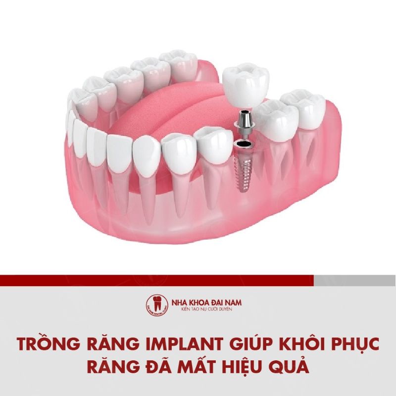 Dia chi trong rang Implant khoi phuc rang da mat tai Quy Nhon
