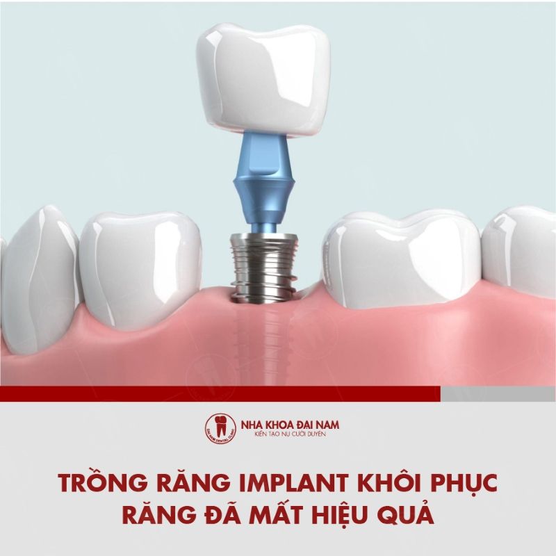 Trong rang Implant giup khoi phuc rang da mat tai Nha khoa Sai Gon