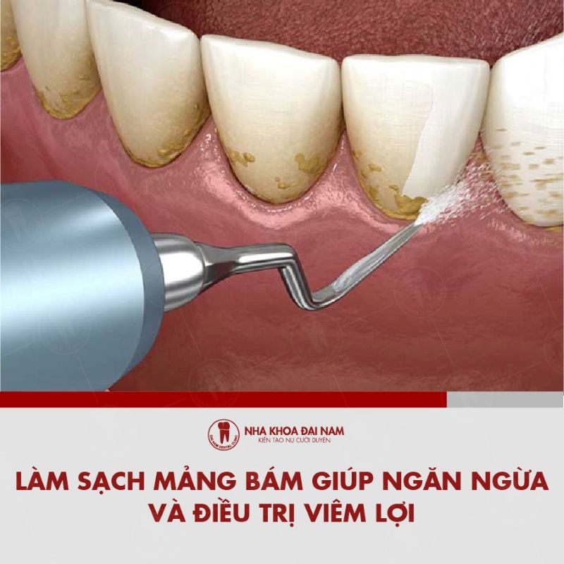 Lam sach mang bam giup ngan ngua va dieu tri viem loi