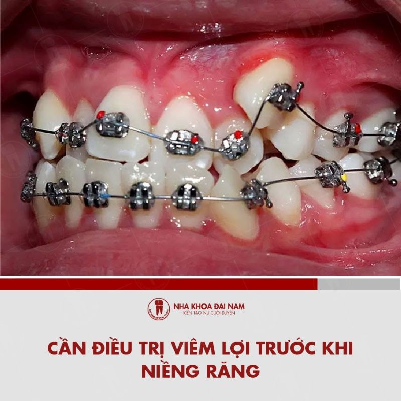 Can dieu tri viem loi truoc khi nieng rang