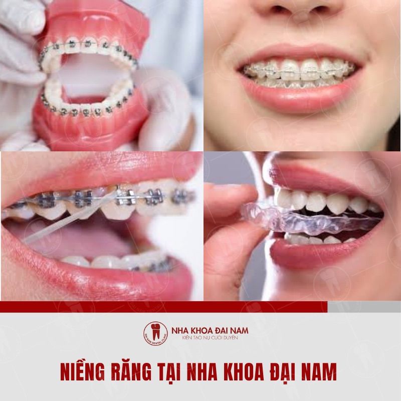  Nieng rang la phuong phap keo chinh rang ve lai dung vi tri mong muon