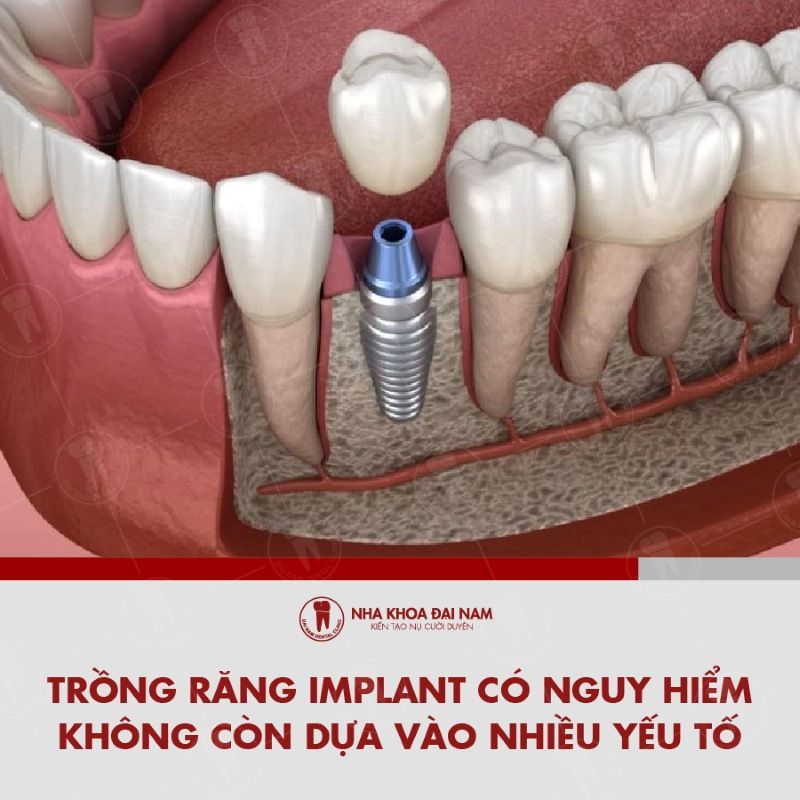 Trong rang implant co nguy hiem khong con dua vao nhieu yeu to