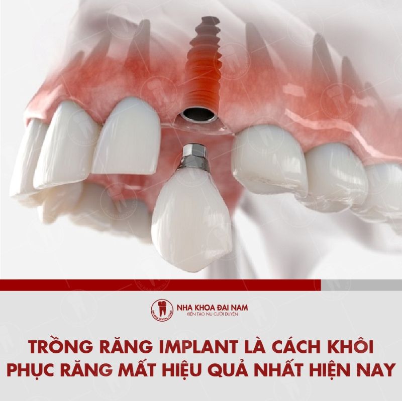 Trong rang Implant la cach khoi phuc rang mat hieu qua nhat hien nay
