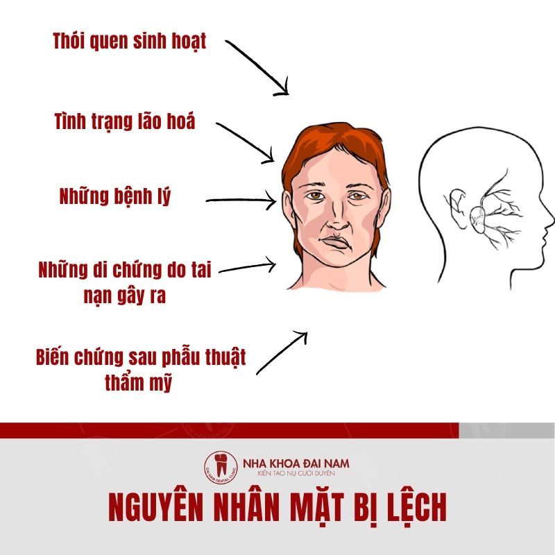 5 nguyen nhan pho bien gay ra tinh trang lech mat