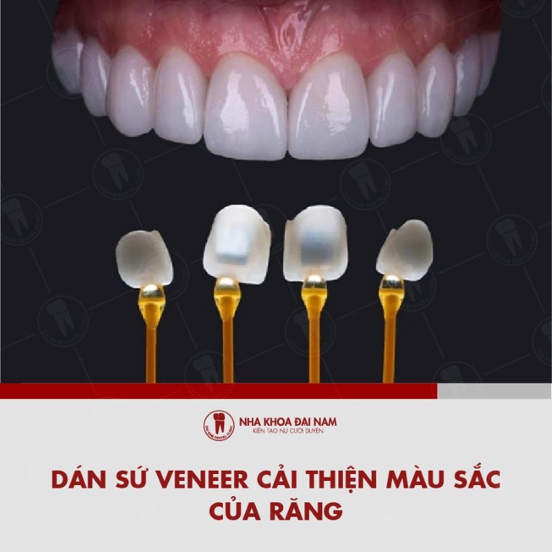 Dan su Veneer giup cai thien mau sac cua rang