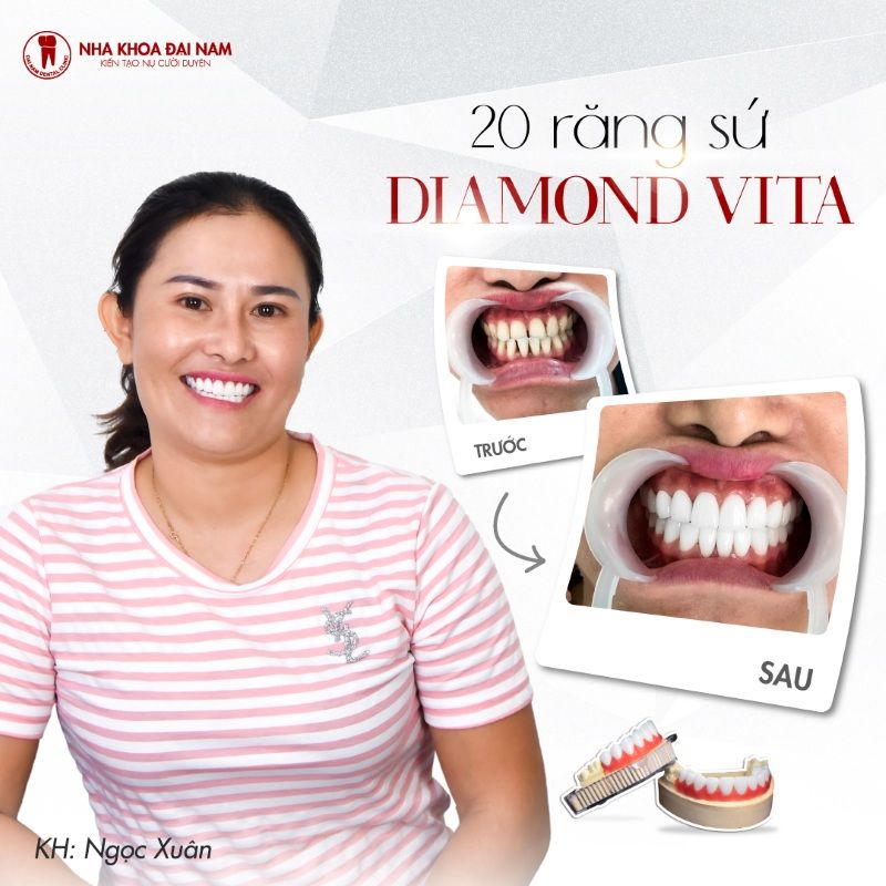 Khach hang lam rang su Diamond Vita tai Nha khoa Dai Nam