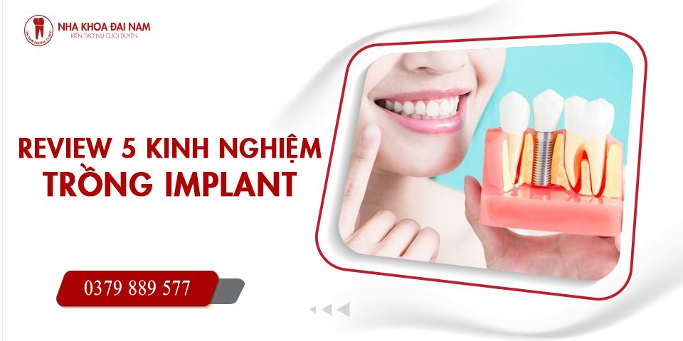 Review 5 kinh nghiệm trồng răng Implant - Nha khoa Đại Nam