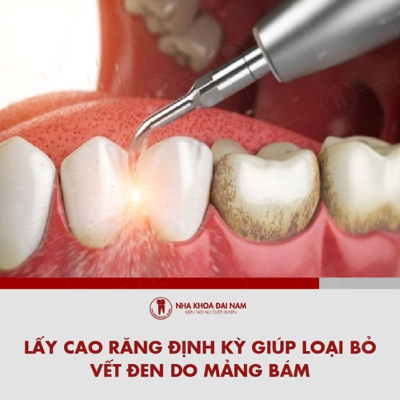 Lay cao rang dinh ky giup loai bo vet den do mang bam gay ra