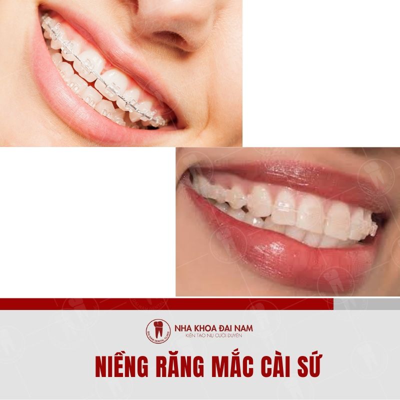 Nieng rang mac cai su mang lai tinh tham my va hieu qua cao