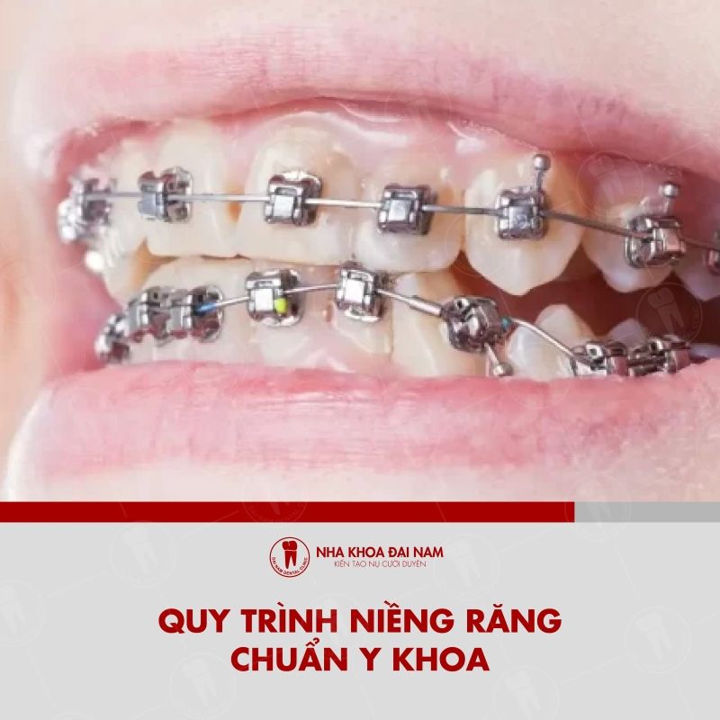 Quy trinh nieng rang chuan y khoa tai Nha khoa Dai Nam