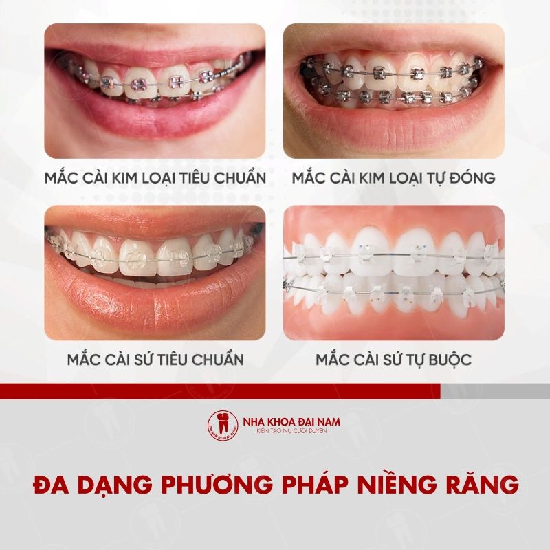 Nha khoa Dai Nam chi nhanh Binh Thanh con tap trung sau ve dich vu nieng rang