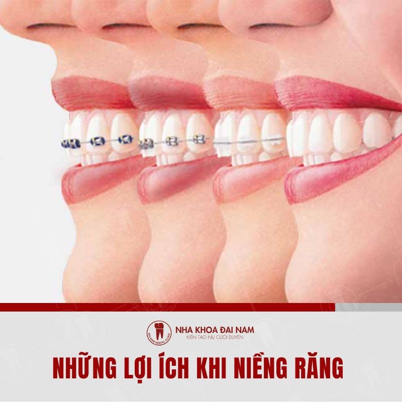 Nhung loi ich khi nieng rang tai Phan Rang