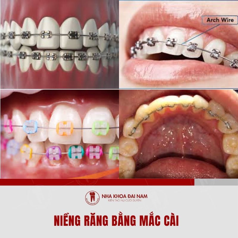 Nieng rang bang mac cai tai Nha Khoa Dai Nam 