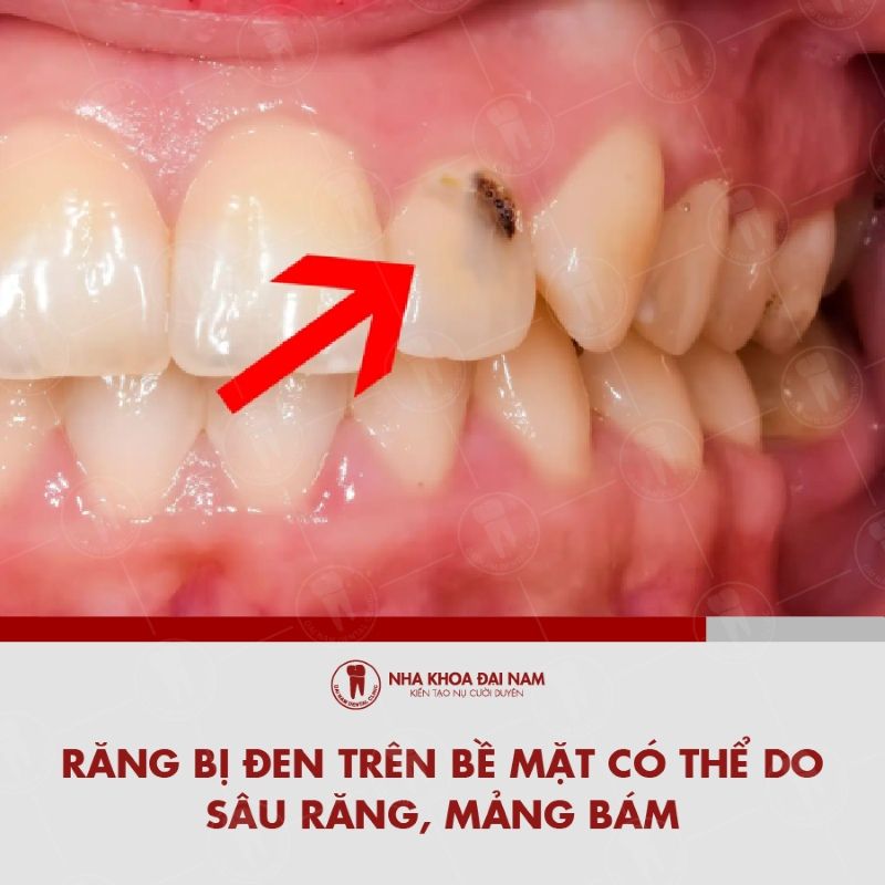 Rang bi den tren be mat co the do sau rang mang bam nhiem mau