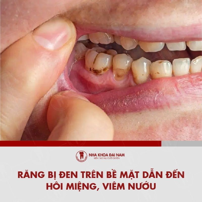 Cac mang bam va vet den la nguyen nhan dan den hoi mieng viem nuou