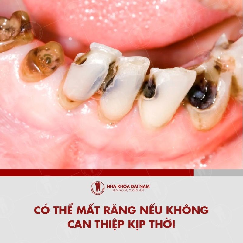 Benh ly co the lam mat rang neu khong dieu tri kip thoi