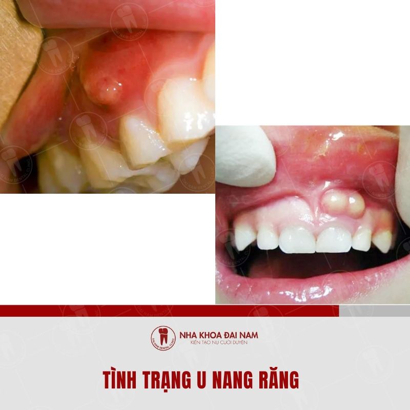 U nang rang la benh ly nghiem trong neu khong kip thoi dieu tri
