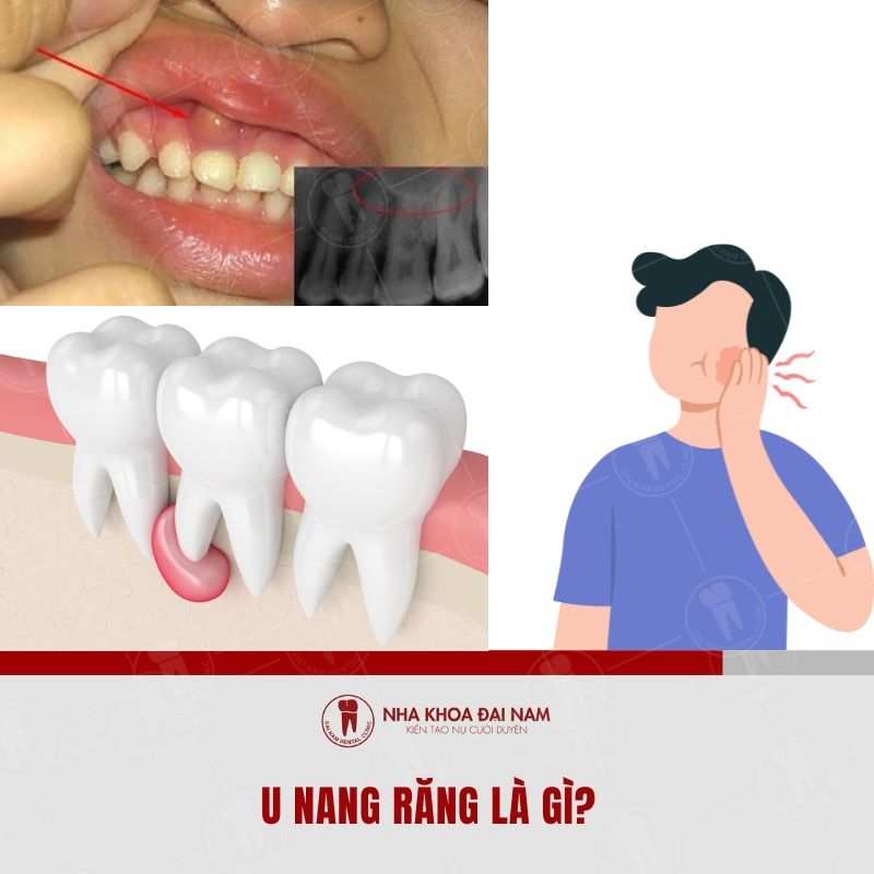 U nang rang duoc hinh thanh tu nhung rang sau hay bi nhiem trung lau dai trong vung mo quanh rang