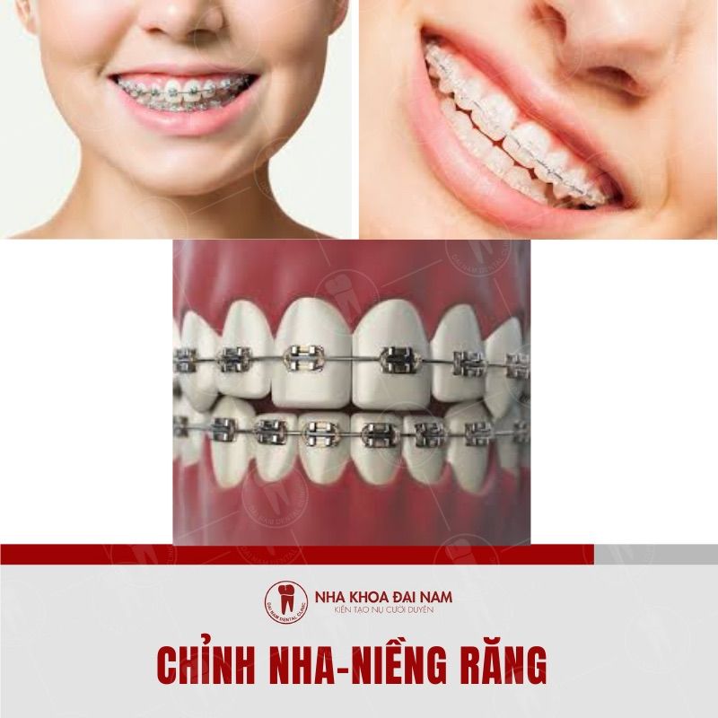 Nieng rang la thu thuat keo chinh rang giup rang deu hon