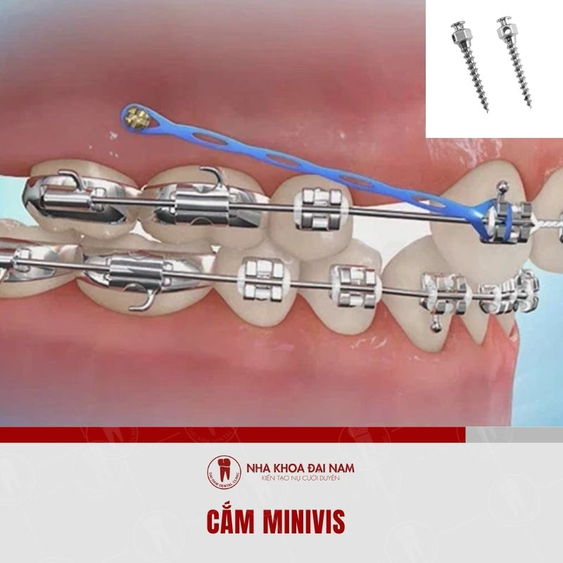 Minivis duoc lam bang Titanium co hinh dang xoan oc cam vao xuong ham
